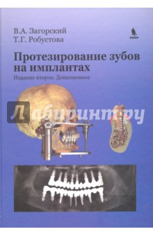 Протезирование зубов на имплантатах