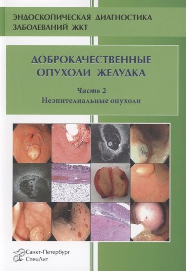 Доброкачественные опухоли желудка Часть 2 Неэпителиальные опухоли