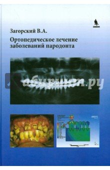 Ортопедическое лечение заболеваний пародонта